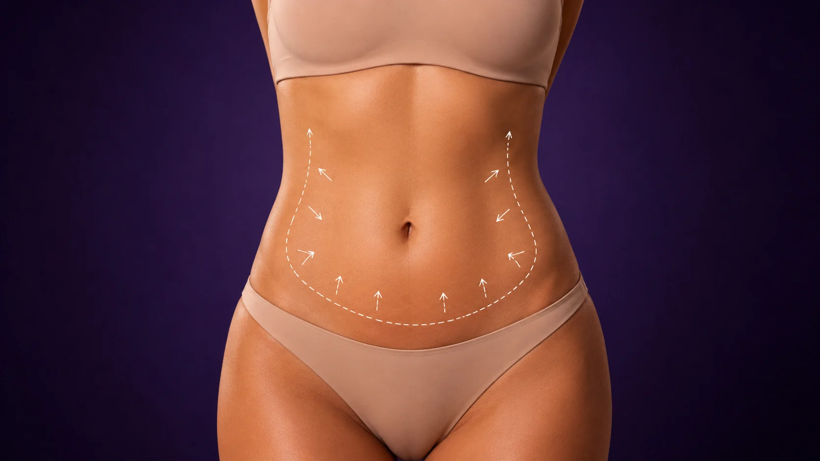 Fettabsaugung Bauch – Frau mit markierter Bauchzone
