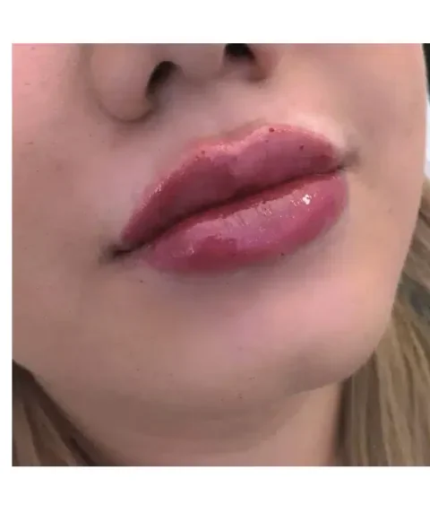 Lippen aufspritzen Ergebnis 1 – Patientin mit natürlich vollen Lippen