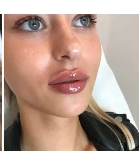Lippen aufspritzen Ergebnis 2 – Patientin mit natürlich vollen Lippen