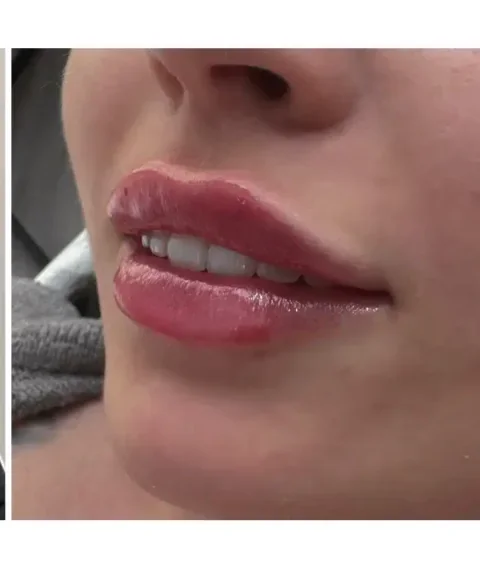 Lippen aufspritzen Ergebnis 3 – Patientin mit natürlich vollen Lippen